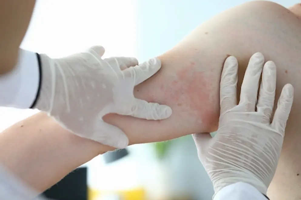 Close up photograph of a examination by doctor of allergic rash.