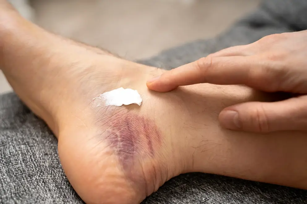 Hand applying soothing cream to bruised ankle for pain relief and healing. 