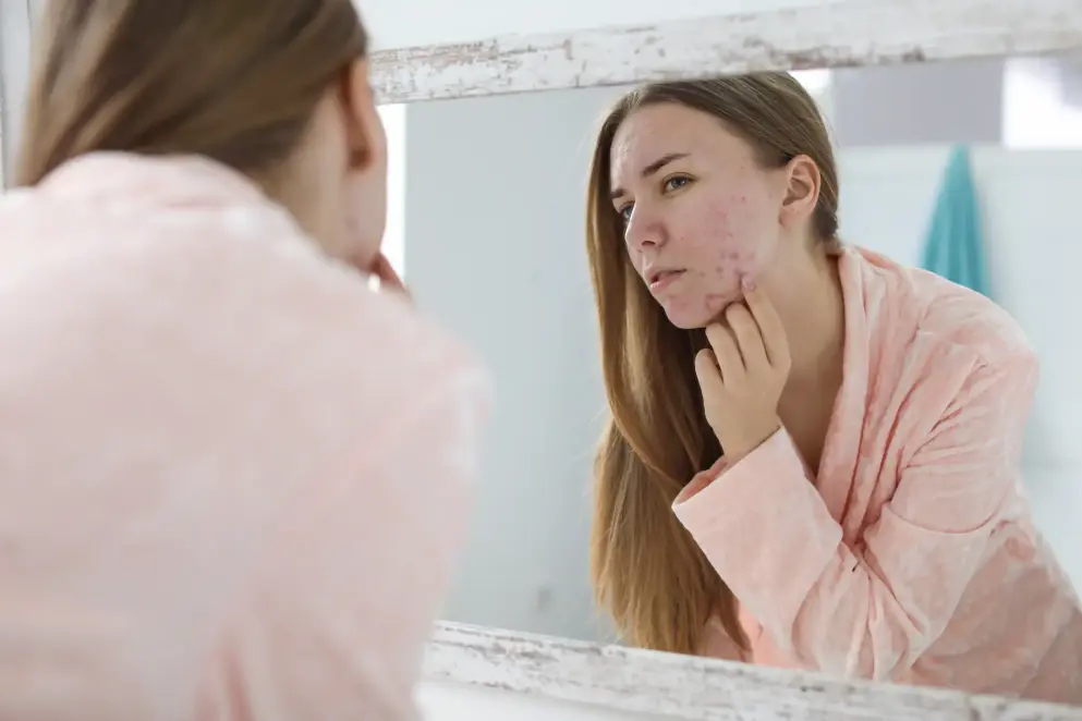 Young woman with visible acne looking at her reflection in a bathroom mirror. 