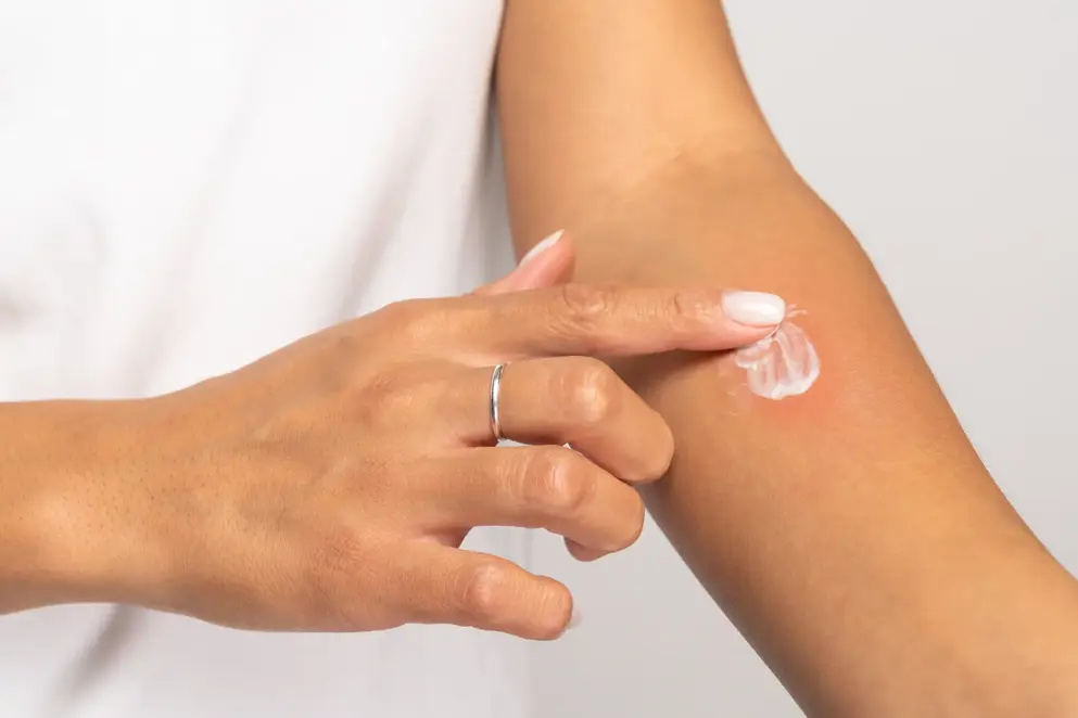 Person applying ointment to a red, irritated patch on forearm. 