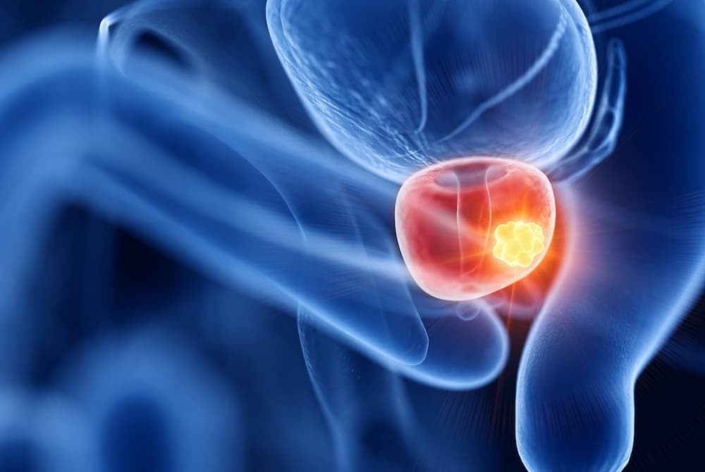 Prostate Cancer