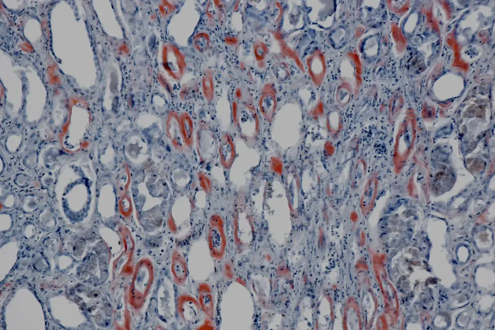 Improving outcomes in AL amyloidosis, Human kidney. Amyloidosis, Congo red