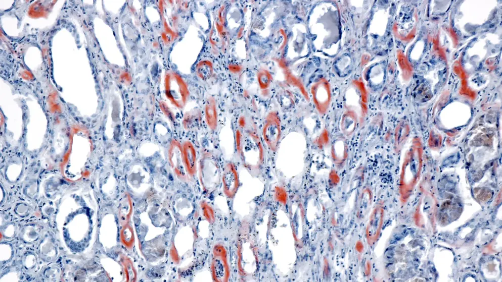 Improving outcomes in AL amyloidosis, Human kidney. Amyloidosis, Congo red