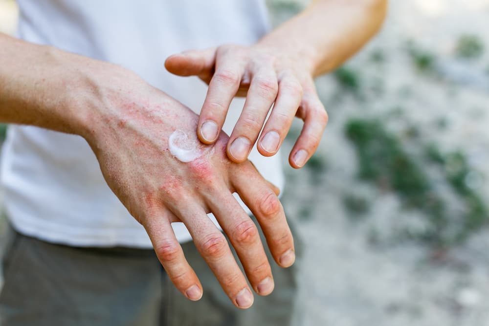 Applying ointment to skin