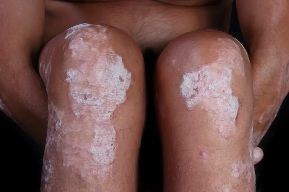 Plaque psoriasis