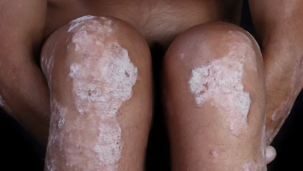 Plaque psoriasis