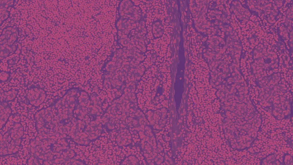 thymoma, a tumor of thymic gland origin with both epithelial and lymphoid components, cell image, pink and purple colours