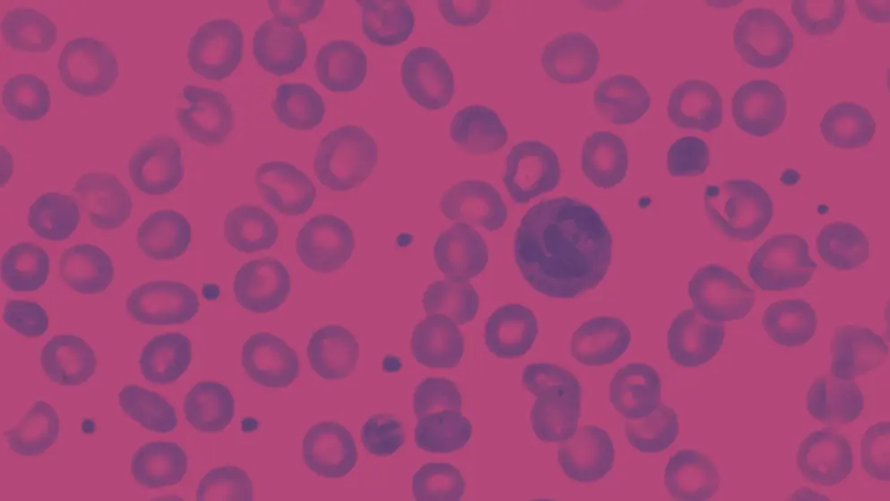 slide blood smear show neutrophil for complete blood count, cell image, pink and purple colours