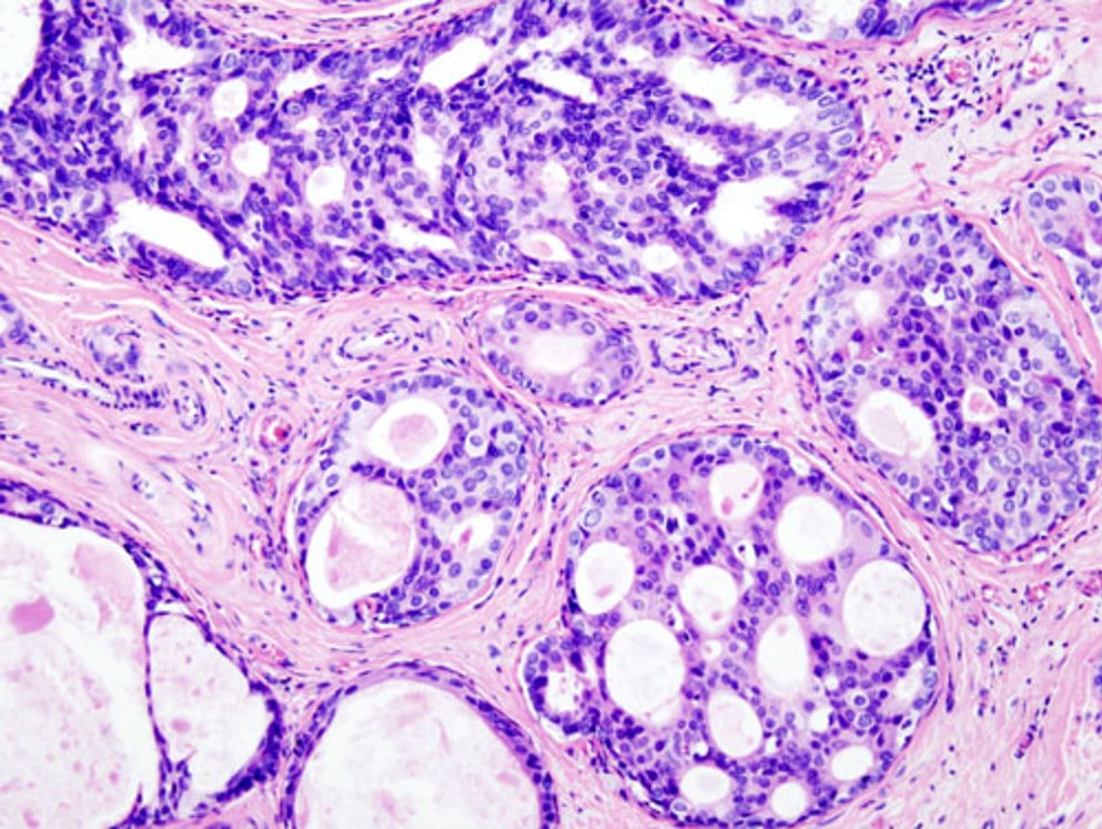 Breast_DCIS_histopathology