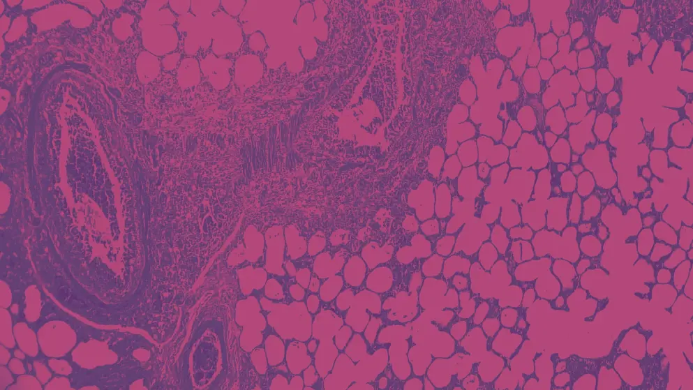 Histopathology of pneumonia, cell image, pink and purple colours