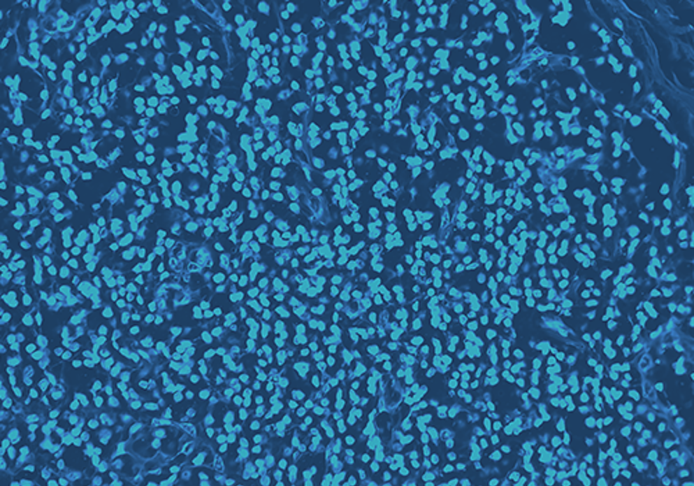 Microscopic image of Hidradenitis suppurativa in axillary mass tissues, blue overlay