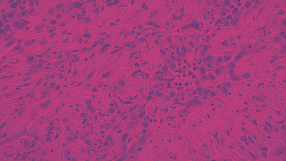 Micrograph of mesothelioma in lung pleura, rendered in pink