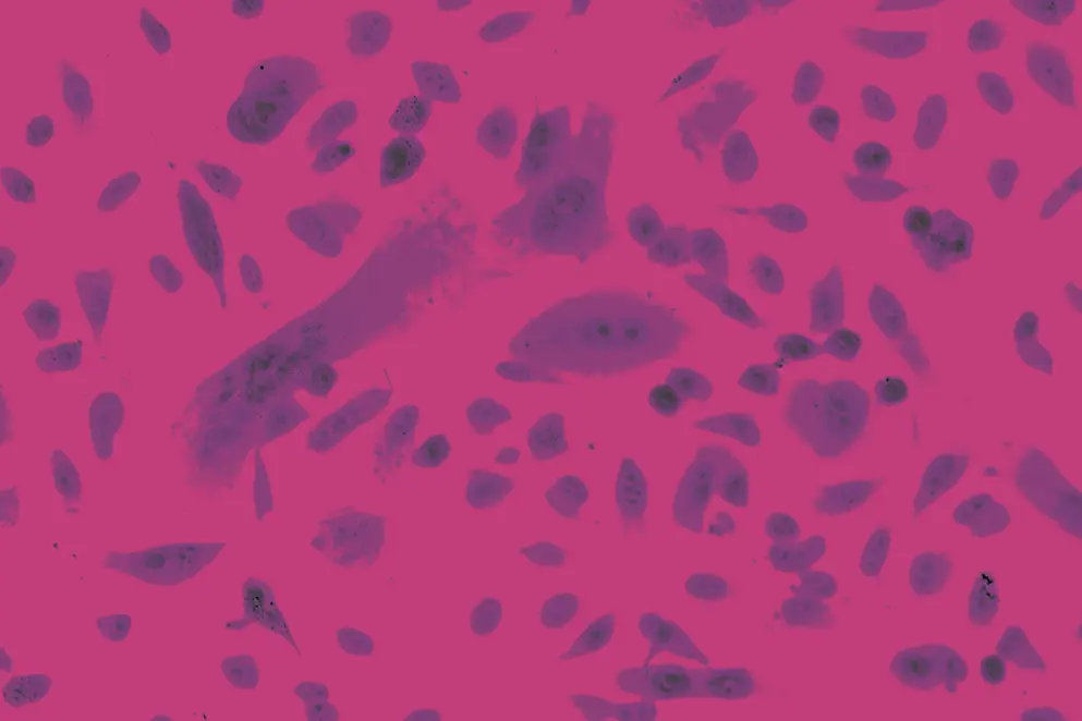 AdobeStock_111509482 Photo of Prostate cancer cells under microscope, pink and purple tones.