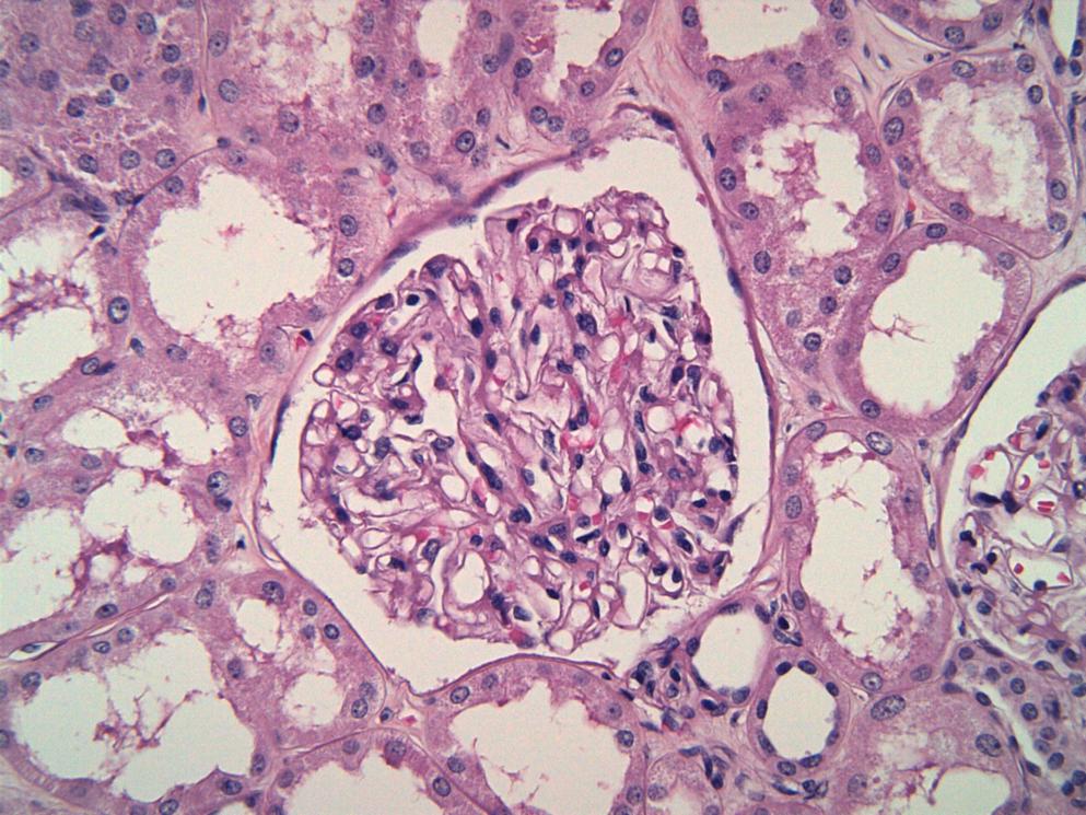 C3 glomerulopathy (C3G)
