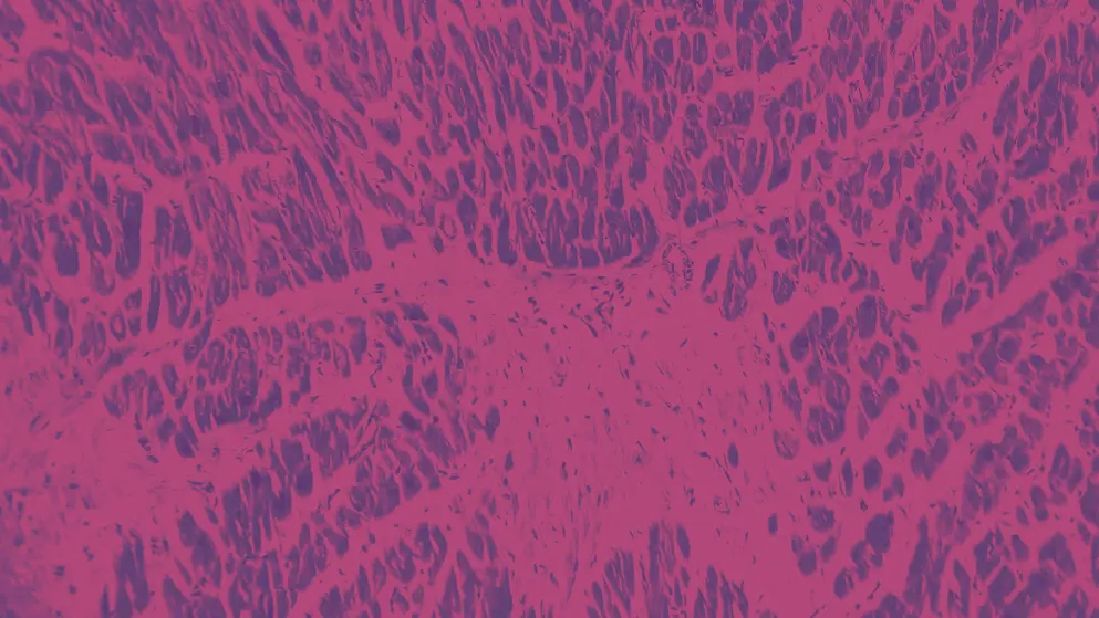 Acute myocardial infarction, Heart Tissue, cellular image, pink and purple colours