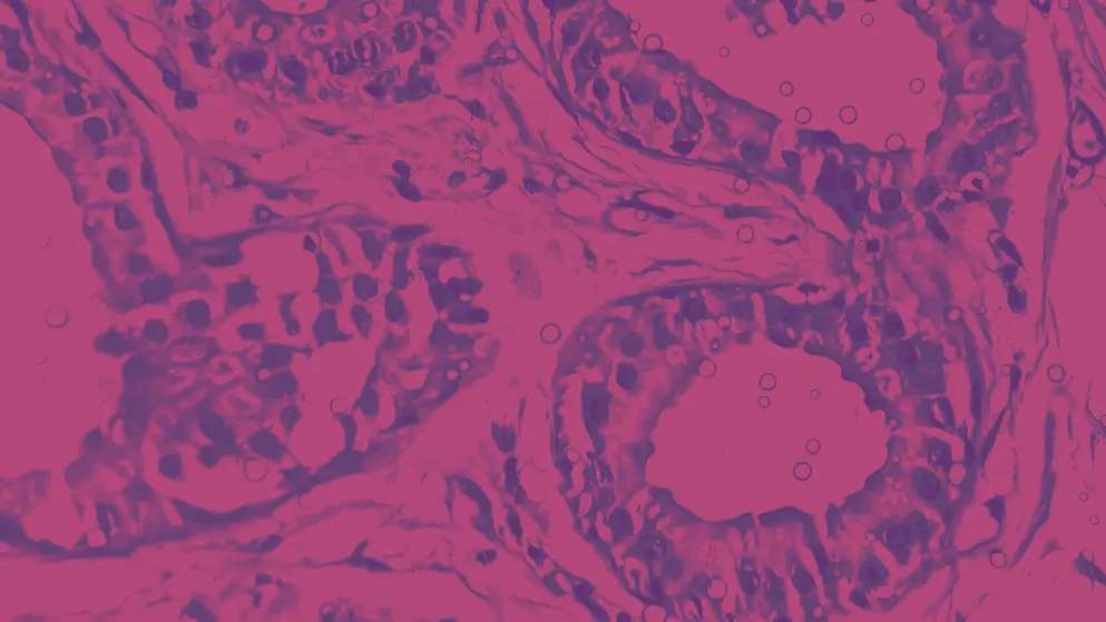 Hidradenitis suppurativa in axillary mass tissue under microscope, pink and purple