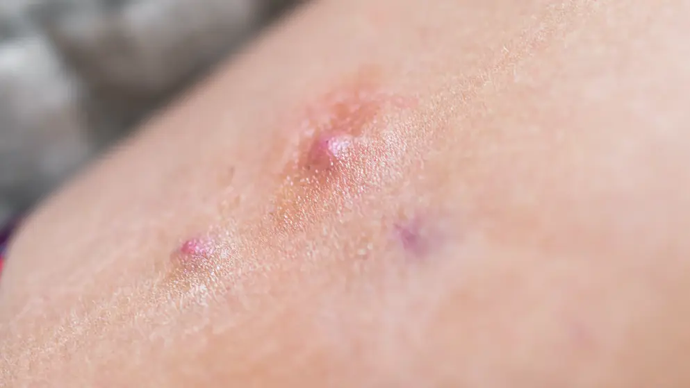 Adobe_514511258 Patient with Hidradenitis suppurativa (HS)
