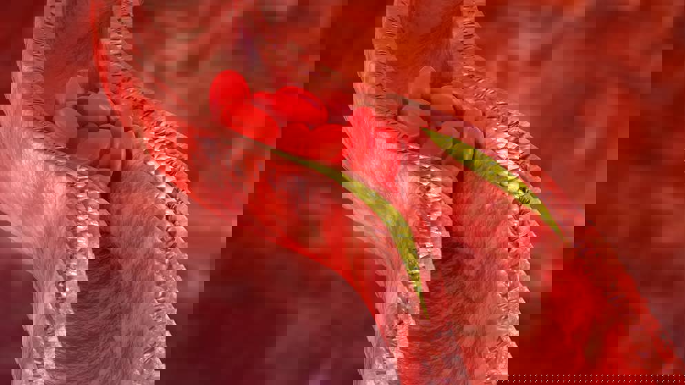 Lipids in ASCVD