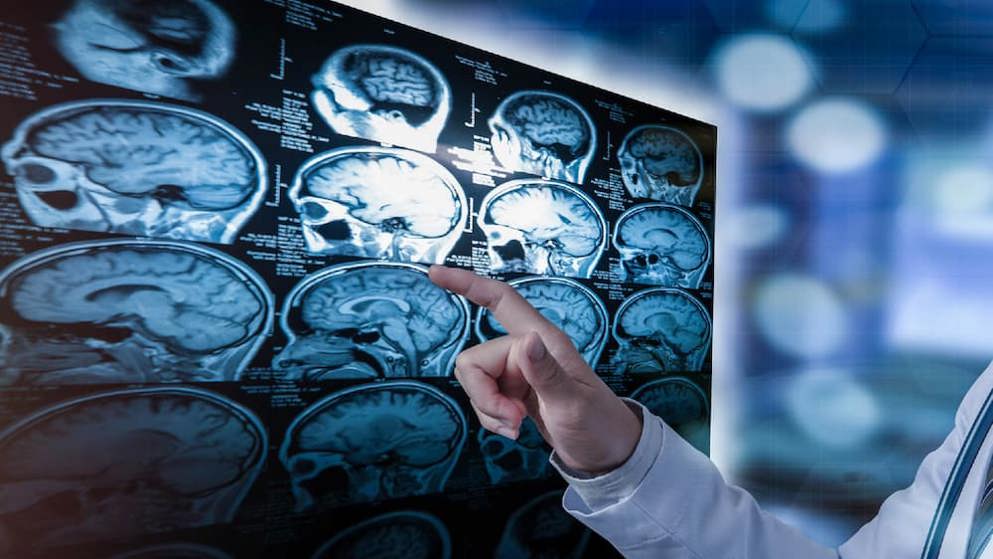 Understanding Multiple Sclerosis