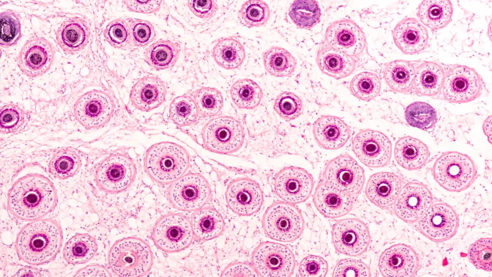 Photomicrograph of the human scalp, showing histology of hair follicles, cut as a tangential cross section. Pink colours