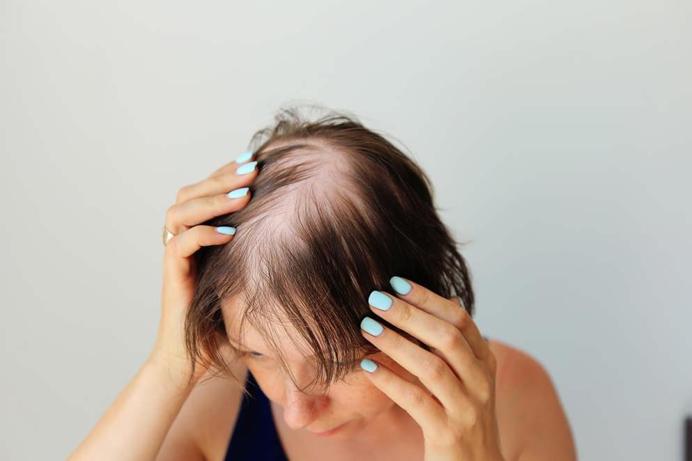 Alopecia areata