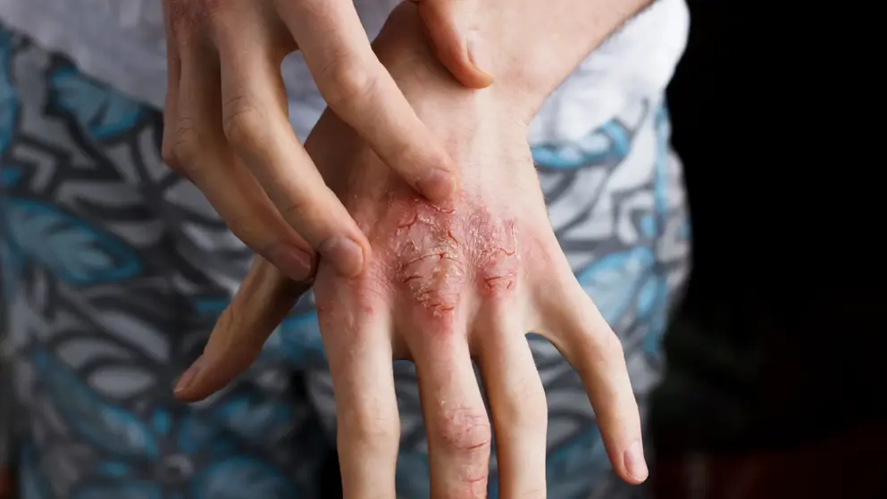 Atopic derm hand