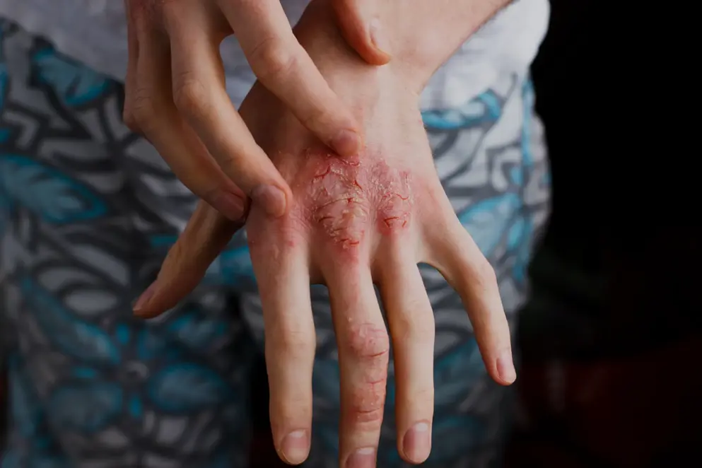 AdobeStock_137058013 Atopic dermatitis hand
