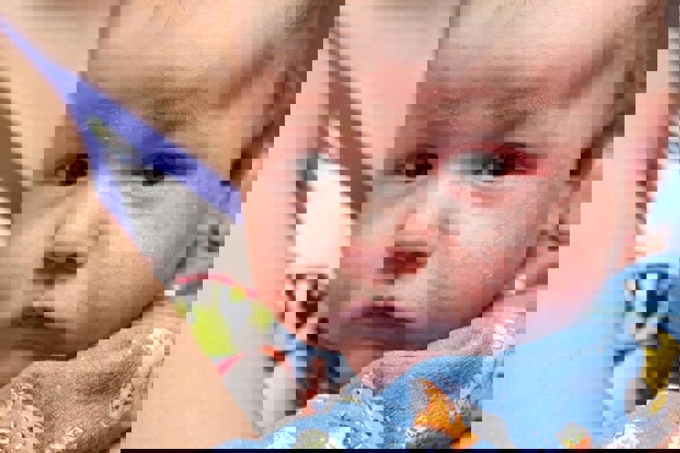 Atopic Dermatitis