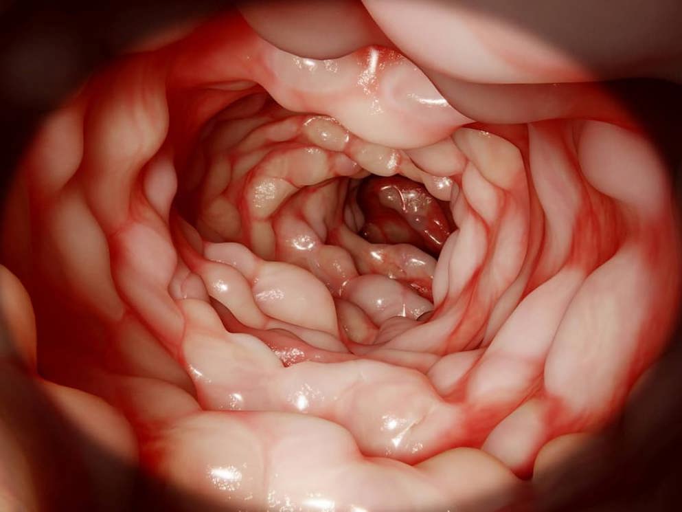 Ulcerative Colitis