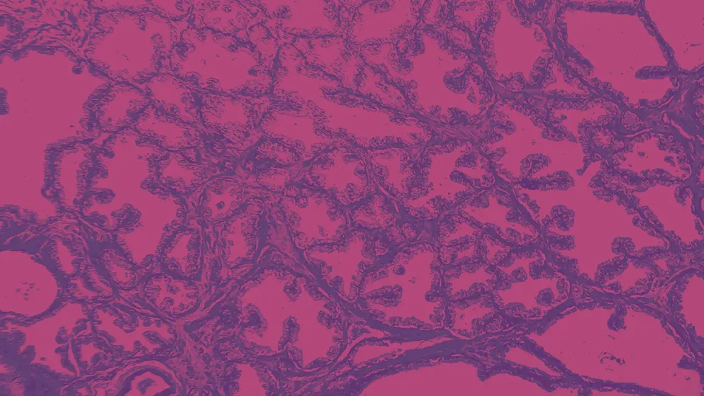 light micrograph of prostate cancer, pink and purple