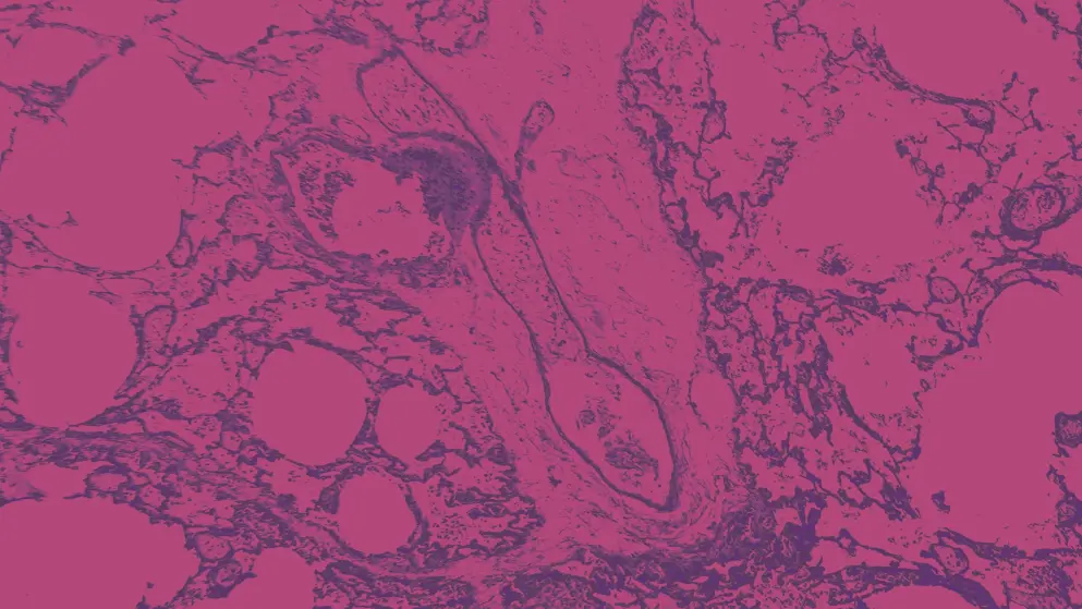 Transparent thrombosis, micrograph, pink and purple