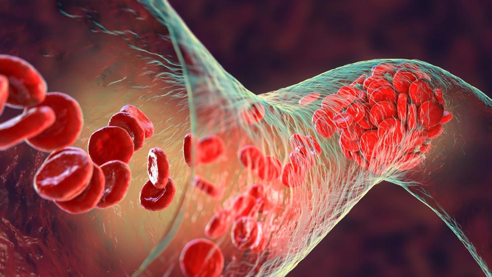 Blood clot made of red blood cells