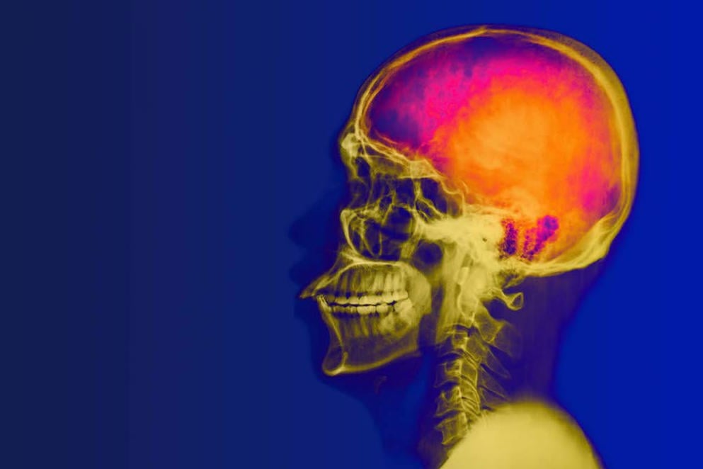AdobeStock_69831449 Anticoagulation therapy for stroke prevention