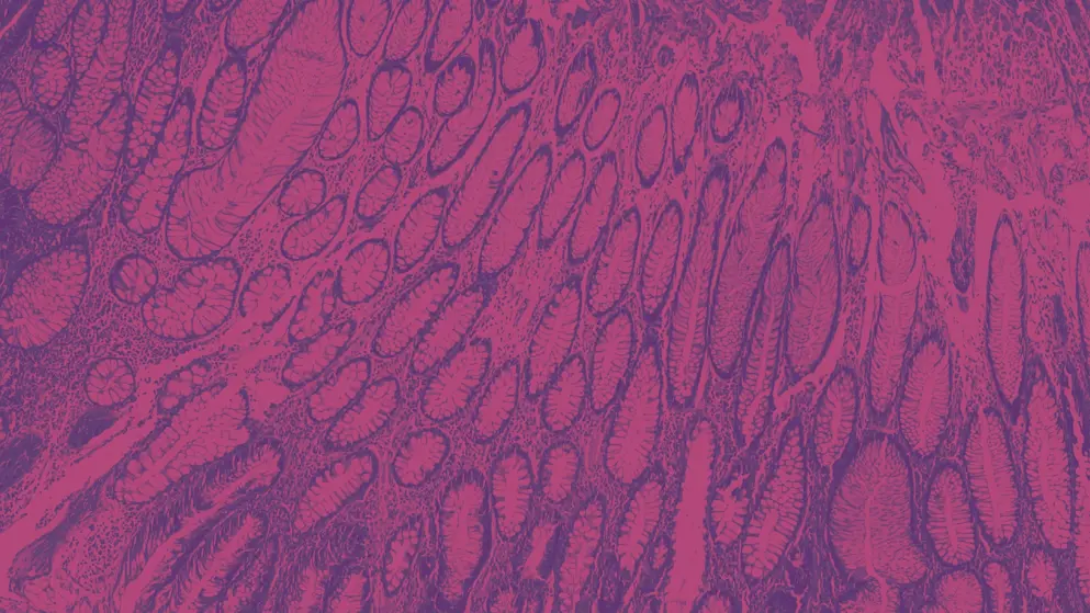 adenonocarcinoma from human breast cancer, cell image, pink and purple