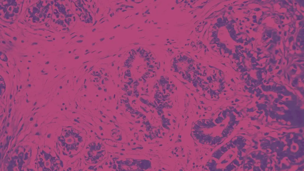 Hard breast cancer light micrograph, pink and purple colours