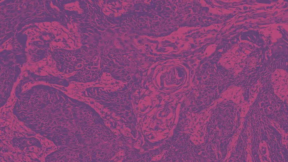 invasive squamous cell carcinoma, Skin cancer micrograph, pink and purple colours