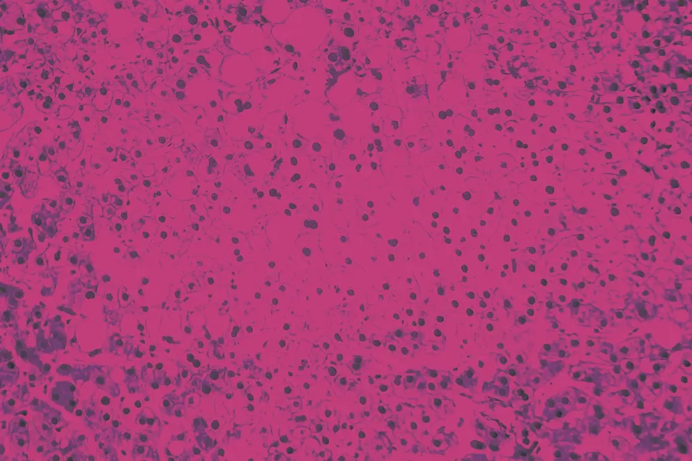 AdobeStock_277862822 Histopathology of liver steatosis, or fatty liver. Light micrograph, photo under microscope