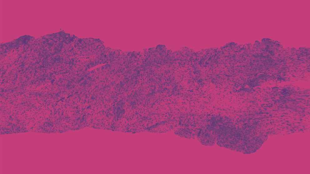 Low magnification microscopic image of a desmoid tumor in purple with a pink background. 