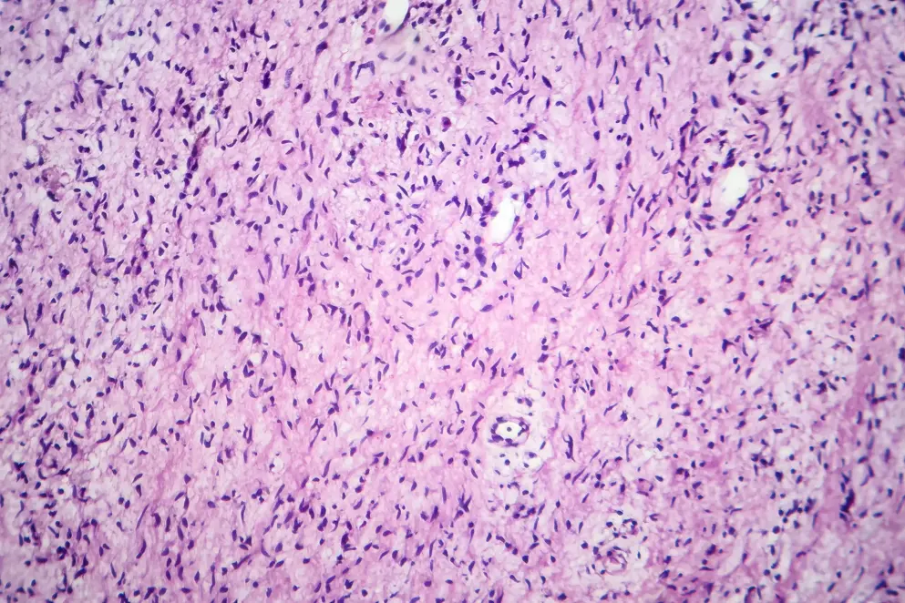 Microscopic image of tissue showing purple cells on a pink background.