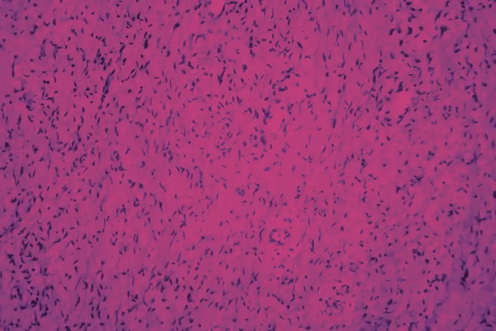 Microscopic image of tissue showing purple cells on a pink background.