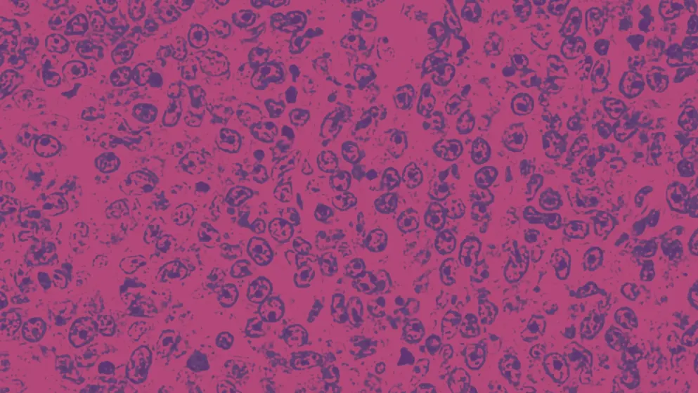photomicrograph of a diffuse large B-cell lymphoma (DLBCL) a type of non-Hodgkin lymphoma, Cell image, pink and purple colours