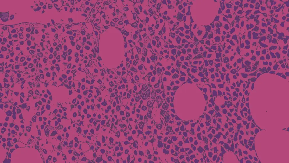 Acute Leukaemia micrograph, pink and purple