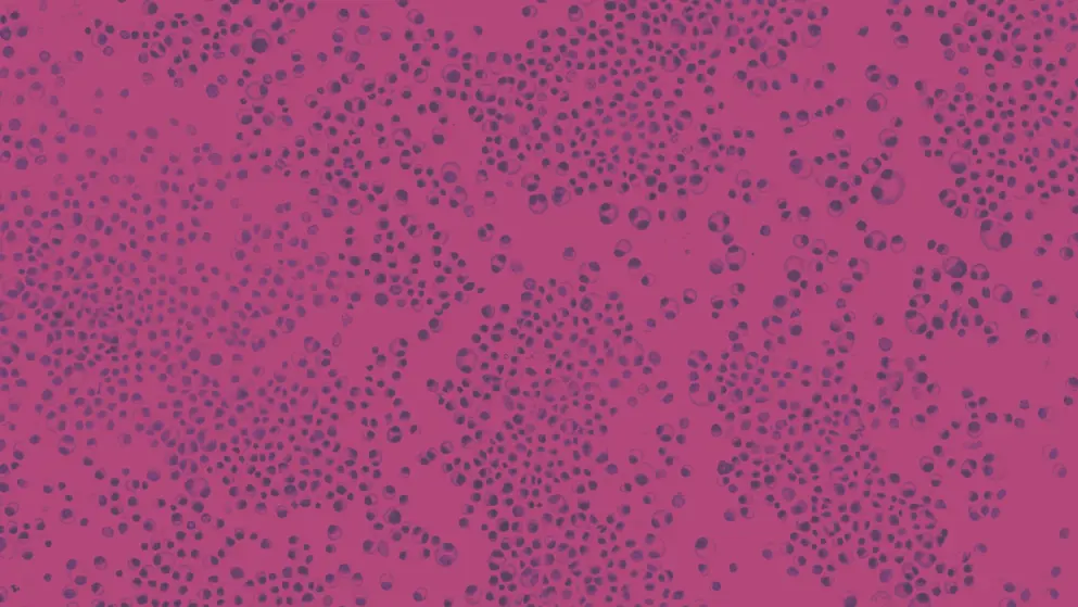 Bone marrow aspirate cytology of multiple myeloma, cell image, pink and purple