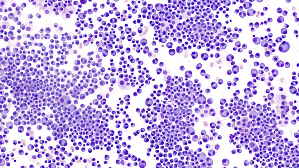 Multiple Myeloma Awareness: Bone marrow aspirate cytology of multiple myeloma, a type of bone marrow cancer of malignant plasma cells, associated with bone pain, bone fractures and anemia