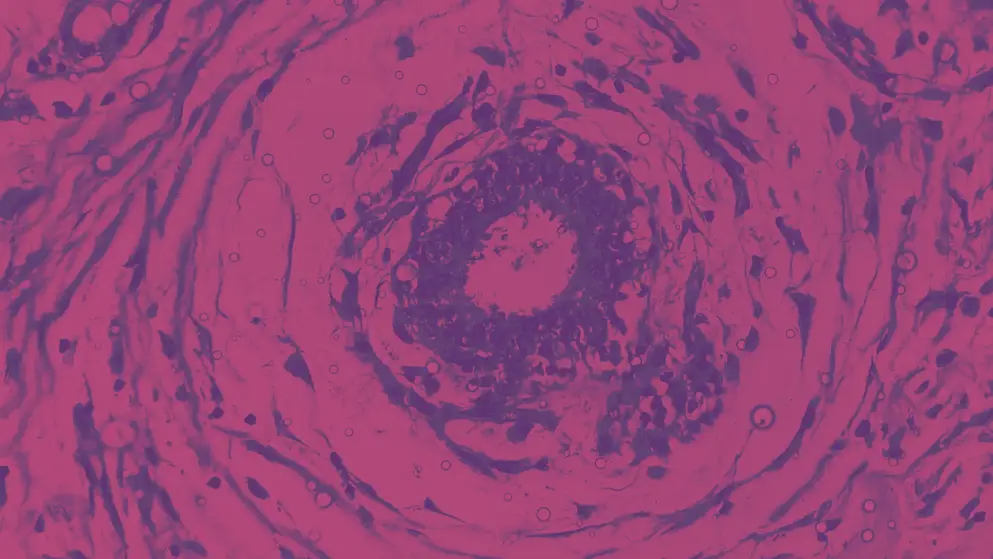 Microscopic image of Hidradenitis suppurativa in axillary mass tissues. showing hyperplasia of follicular epithelium, cell image, pink and purple colours
