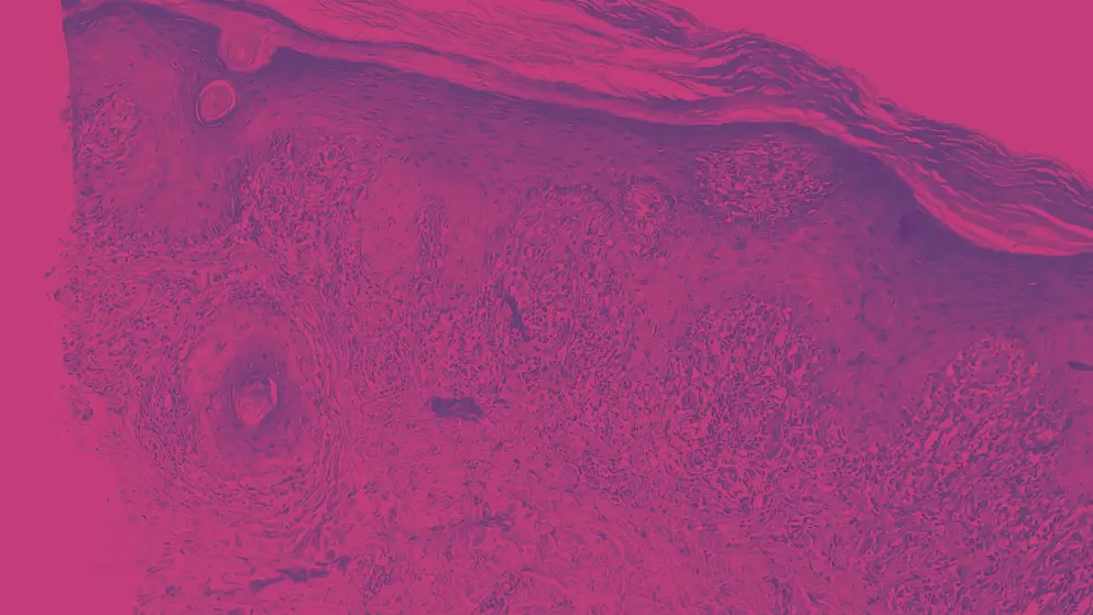 Skin tissue biopsy under microscope, pink and purple