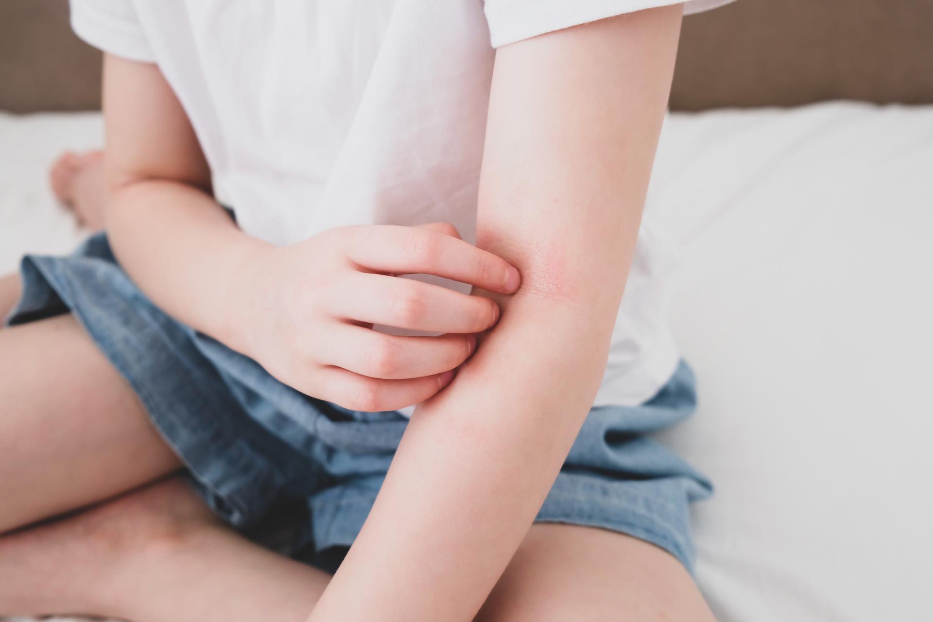 Childhood psoriasis