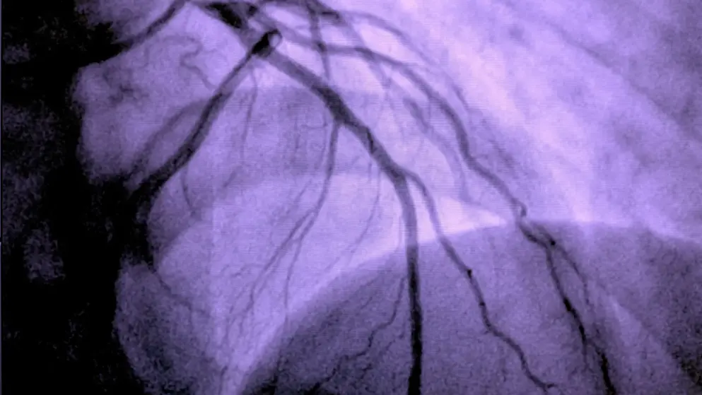 Xray of a human artery, struggling with a coronary condition