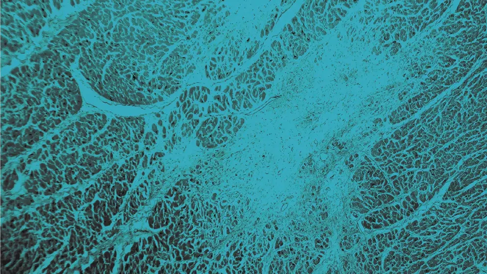 Cellular image, Acute myocardial infarction, Blue overlay
