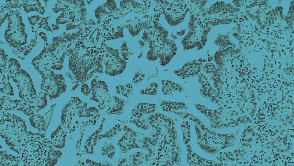 Adenocarcinoma in situ of lung bronchoalveolar carcinoma, cell image, blue overlay